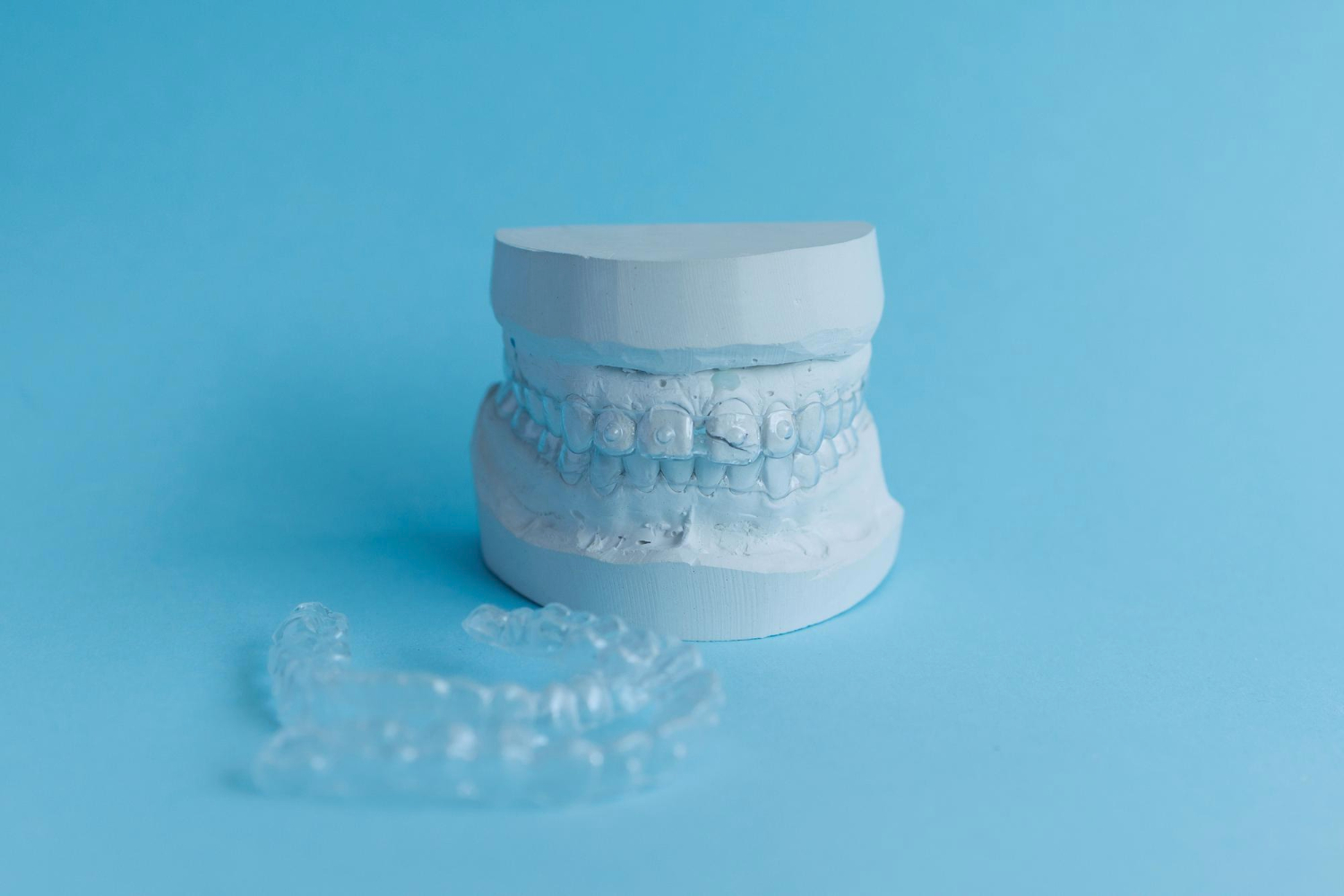 Calco denti in gesso con indosso un allineatore trasparente